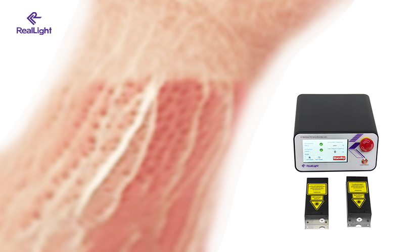 Microchip Lasers: The Rising Star in Photoacoustic Imaging